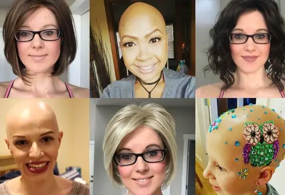 Alopecia Areata femenina: Las mil caras